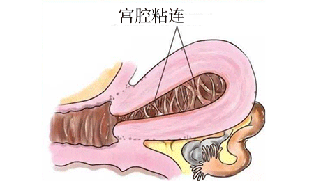 不小心发生宫腔粘连后有哪些治疗方法