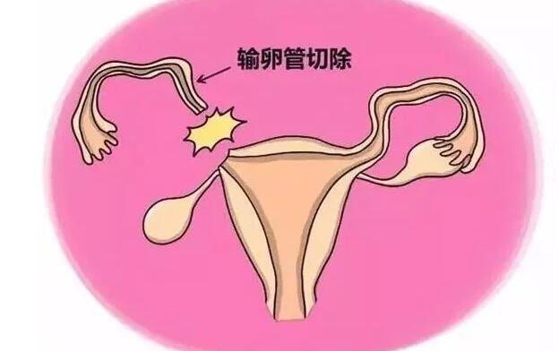 由于各种原因(比如宫外孕)导致一侧输卵管切除,而另外一侧输卵管是