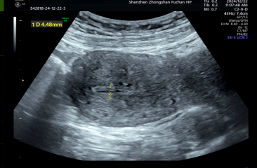 宫腔镜“钥匙孔”手术：5cm肌瘤轻松除，告别“血崩”做自己！