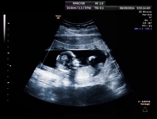 从1枚胚胎到双胎妈妈，她的十年到底经历了什么？