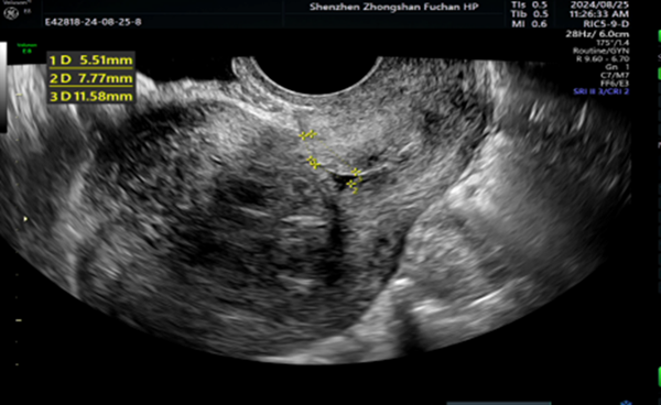 身体里藏了个“山竹”？宫腔镜出手，轻松搞定妇科“麻烦精”！