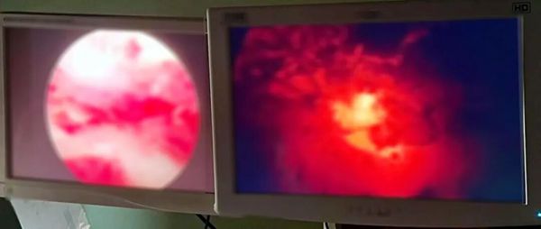 惊心！剖宫产留下的“毫米级隐患”，可能正在影响你的二胎梦！