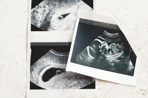 三次怀上又“溜走”，35岁妈妈心碎！医生却说：这根本不是流产！