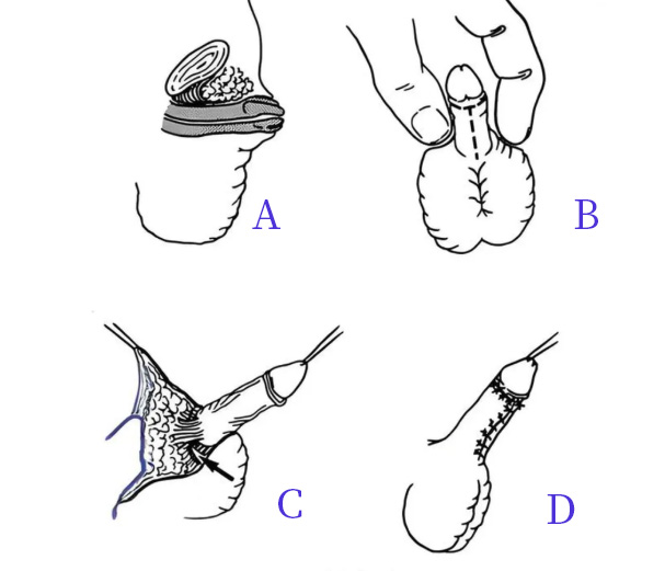 差点就切了！娃的“小辣椒”藏很深？可能是隐匿性阴茎在作怪！