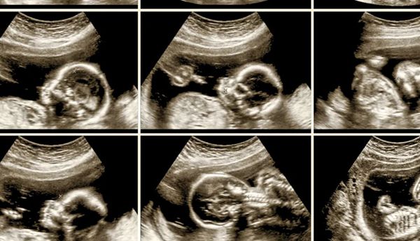 甲减+多囊→试管→一次好孕！精准干预是关键