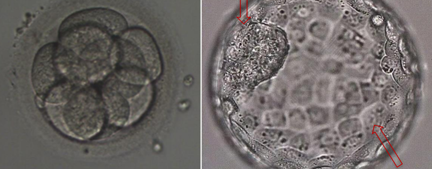 第3天卵裂胚 vs 第5天囊胚?移植哪个成功率更高