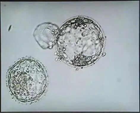 花更多钱做三代试管，胚胎质量就能“升级”吗？