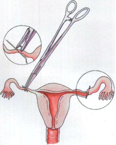 宫外孕手术图片过程图片